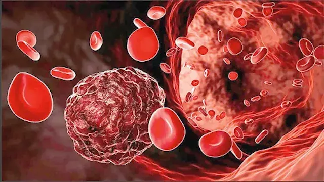 7 أعراض لسرطان الدم قد يظنها ك...