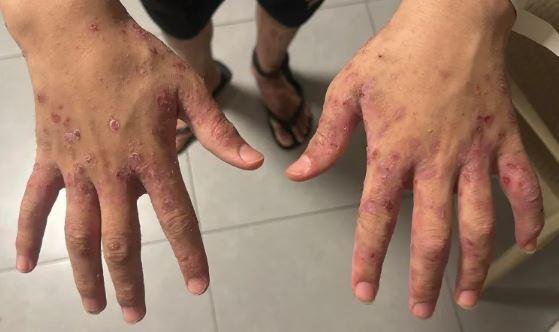 نادي الأسير الفلسطيني: إصابة 1...