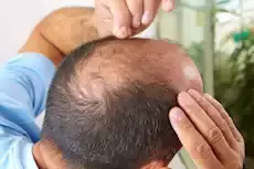 دراسة تكشف مفاجأة.. الصلع المب...
