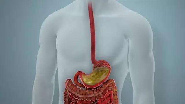 العثور على ذبابة داخل قولون رج...