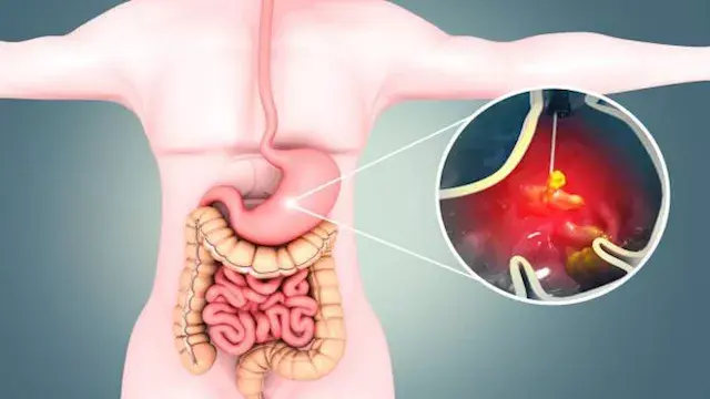 هل يسبب التوتر والضغط النفسي ق...