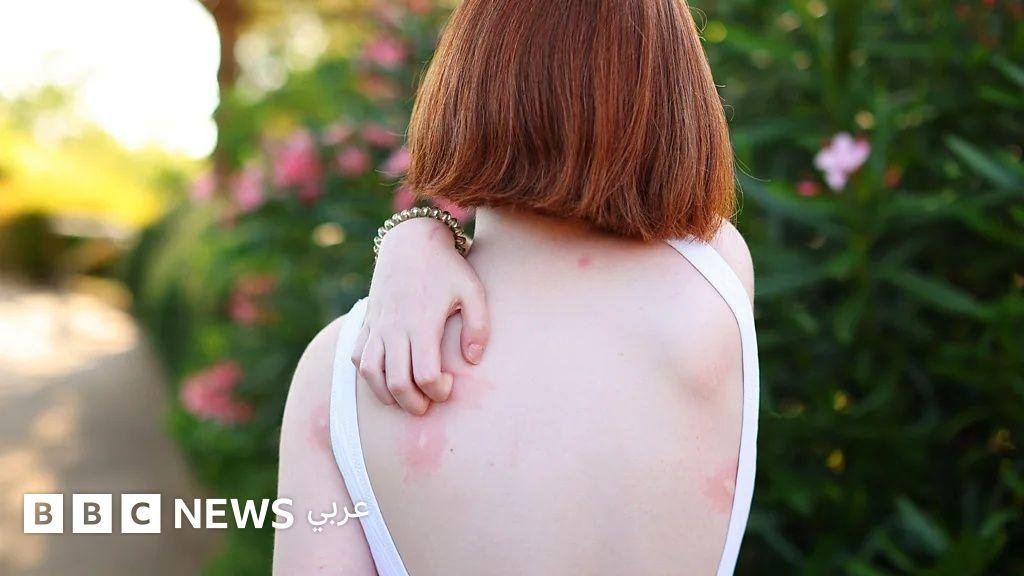 لماذا يلدغ البعوض بعض الأشخاص أكثر من غيرهم؟