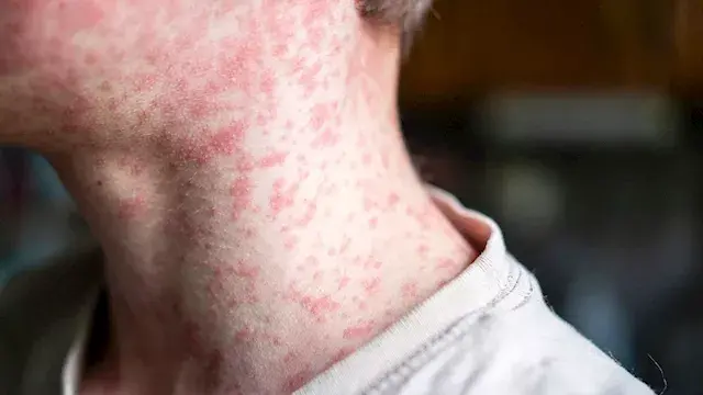 إصابات الحصبة في أمريكا تسجل أ...