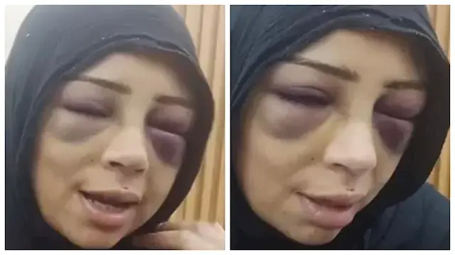 "وشي اتشوّه".. فتاة بورسعيد تكشف تفاصيل اعتداء خطيبها السابق عليها (صور)