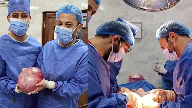 استخراج كيس ضخم من بطن سيدة في...
