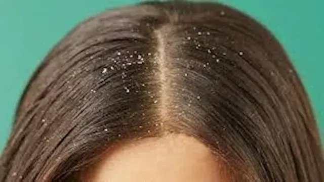 أسباب ظهور قشرة الشعر.. ونصائح للتعامل معها