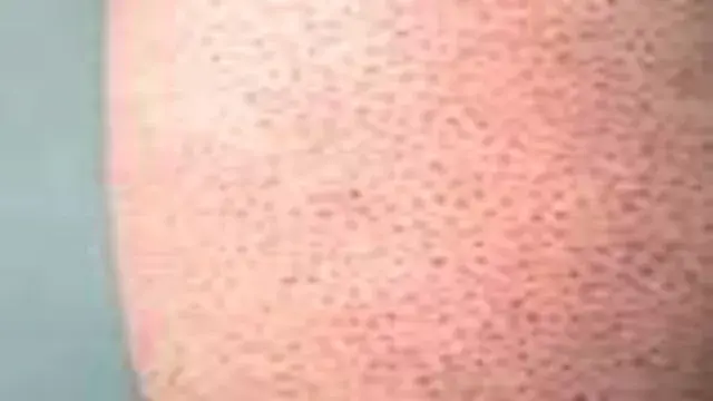 ما سبب ظهور حبوب صغيرة في الذر...