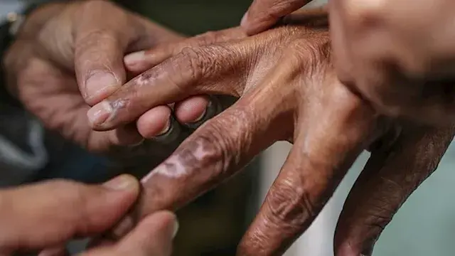الصحة: مرض الجذام قابل للشفاء....