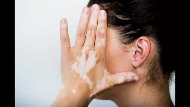 ما أسباب البهاق وكيف تتطور أعر...