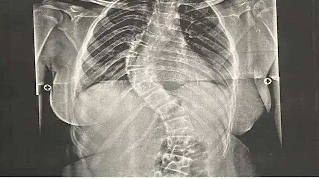 أعادت لها القدرة على الحركة.. مستشفى جامعة الأزهر بأسيوط ينجح في جراحة معقدة لطفلة