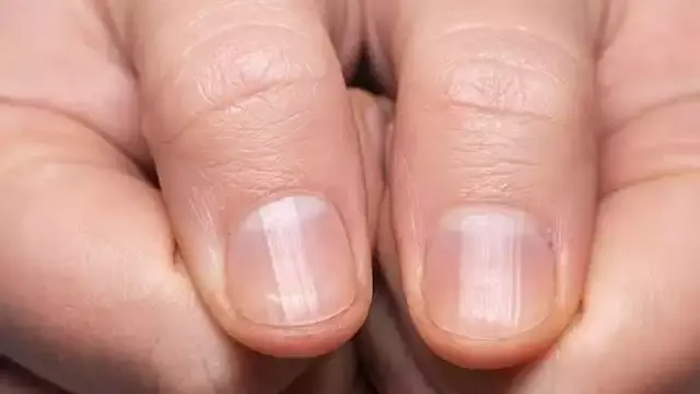 علامة نادرة في الأظافر تلفت ان...
