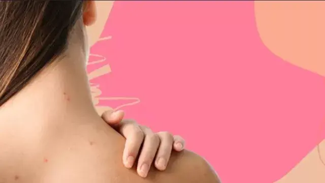 حب الشباب على الظهر في الصيف.....